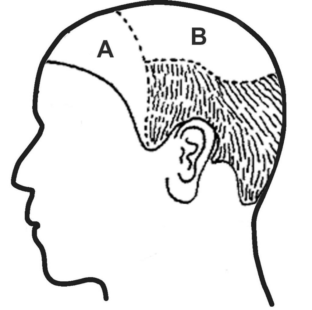 areas of hair loss