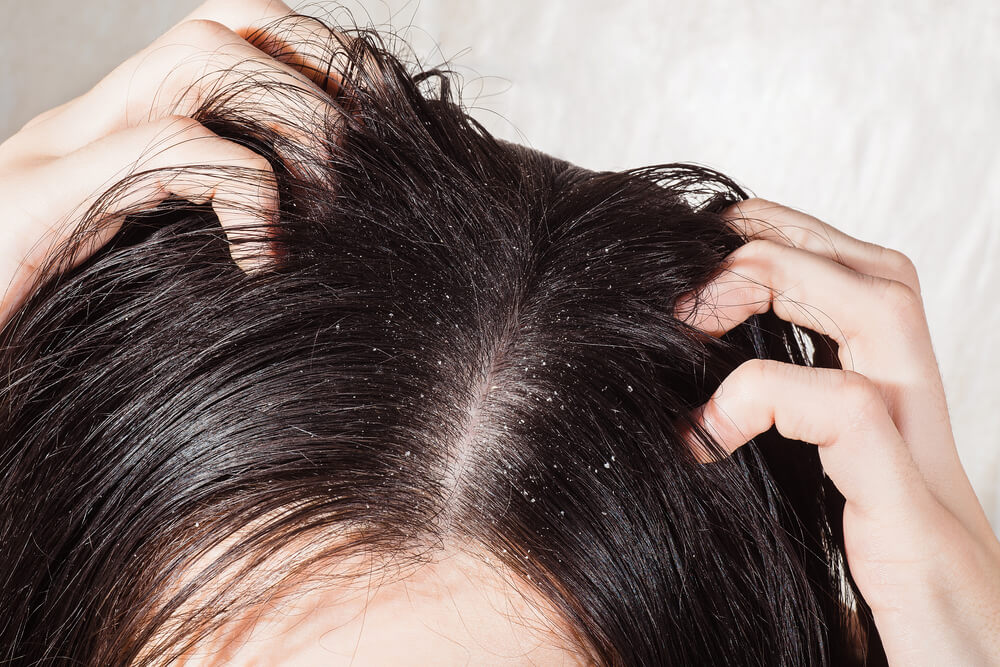 Effective hair mask to get rid of dandruff